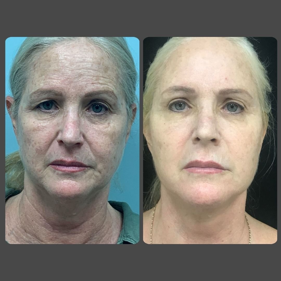 Eyelid Surgery South Florida